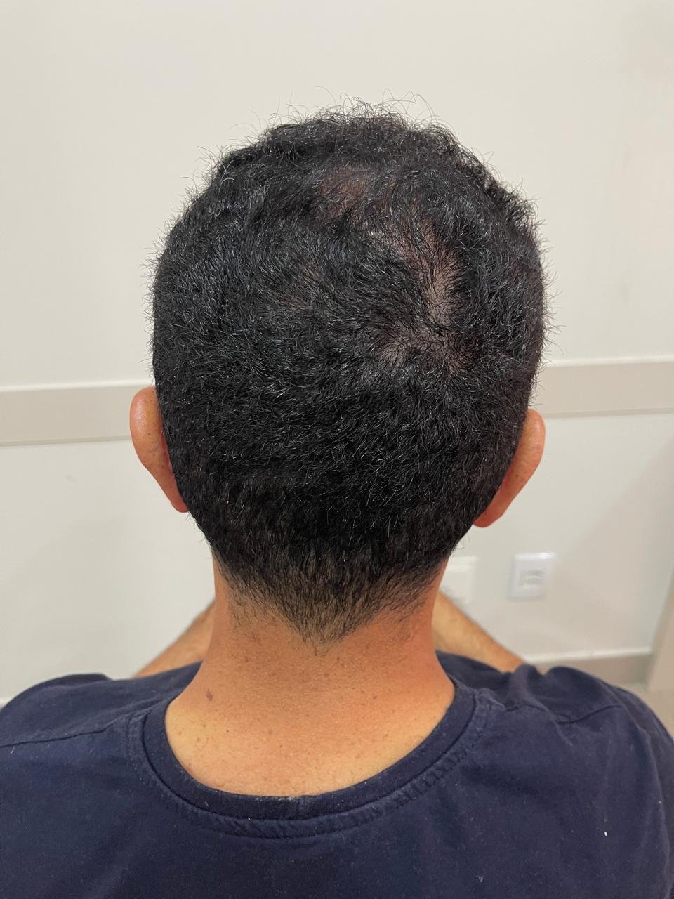 Couro cabeludo de paciente depois do tratamento